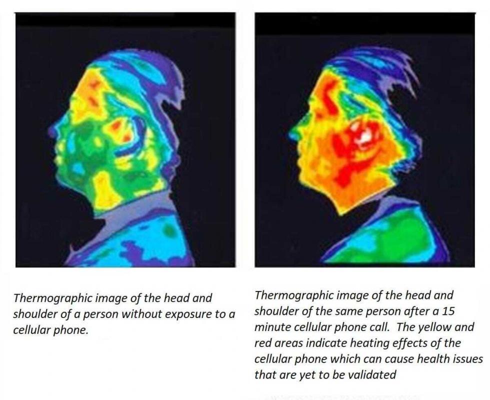 Cellular Phones and Brain Tumors MRA
